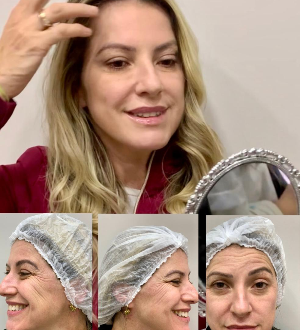 Botox full face Botox full face