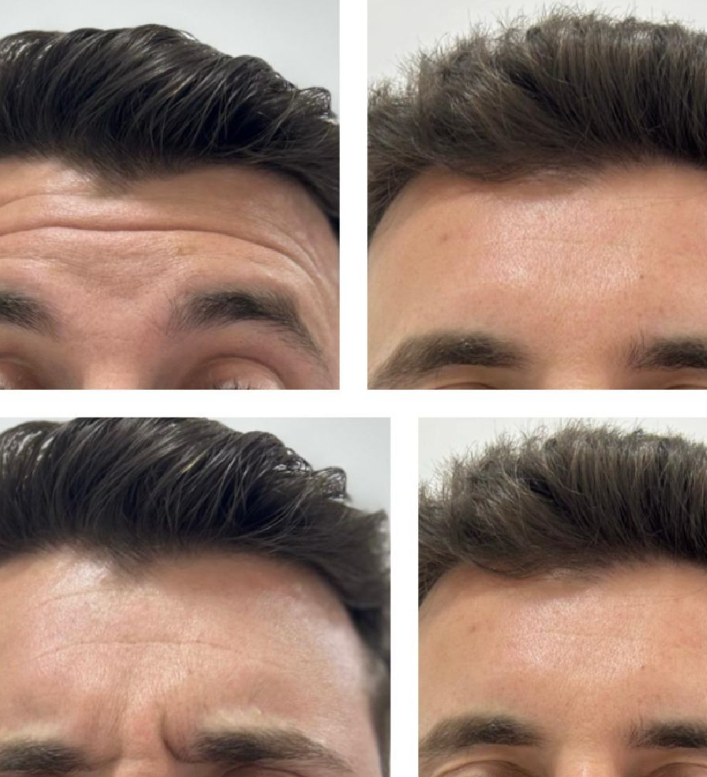 Botox terço superior Botox terço superior