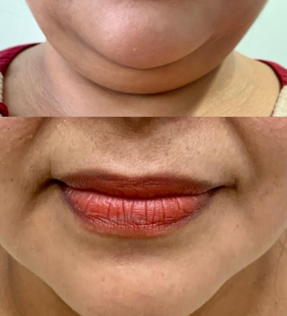 Lipo enzimática de papada