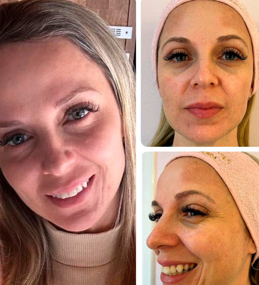 Peeling melasma