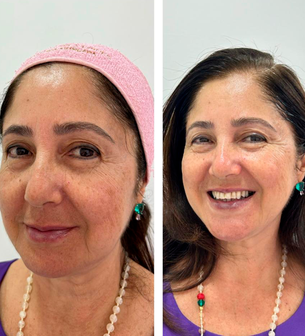 Peeling rejuvenescedor