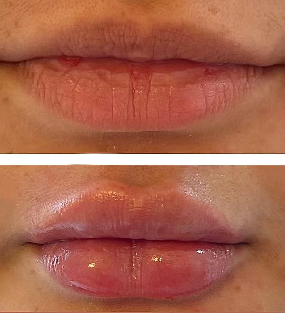 Preenchimento labial