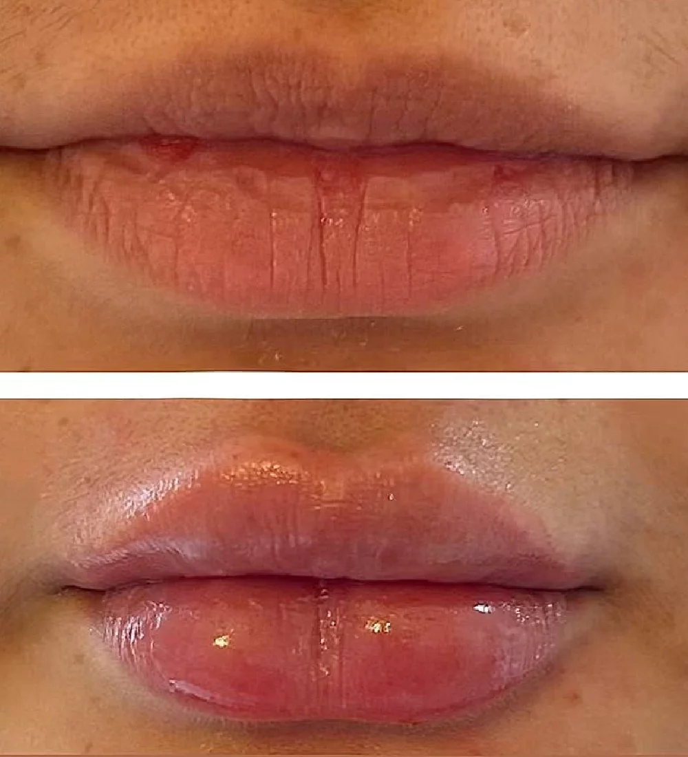 Preenchimento labial